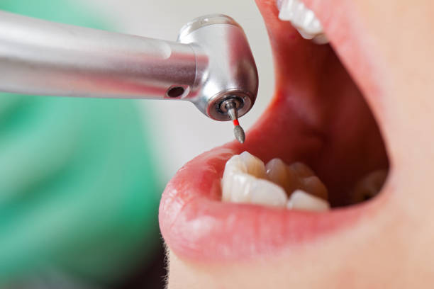 Best Emergency Root Canal Treatment in Higginsville, MO